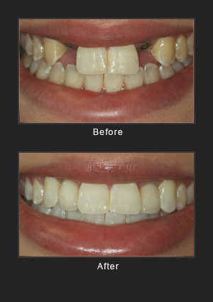 Dental implants before and after