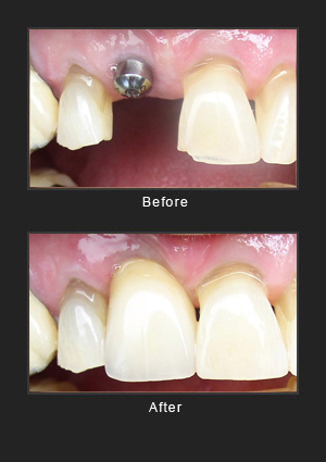Dental implants before and after