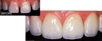 Crowns before and after
